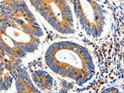 The image on the left is immunohistochemistry of paraffin-embedded Human colon cancer tissue using CSB-PA082992(IGFBP7 Antibody) at dilution 1/50, on the right is treated with synthetic peptide. (Original magnification: ×200)