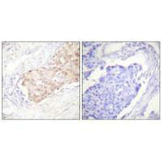 Immunohistochemistry analysis of paraffin-embedded human breast carcinoma tissue using EDD antibody.