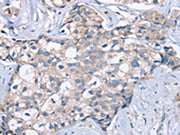 The image on the left is immunohistochemistry of paraffin-embedded Human breast cancer tissue using CSB-PA083173(KCNQ5 Antibody) at dilution 1/60, on the right is treated with fusion protein. (Original magnification: ×200)