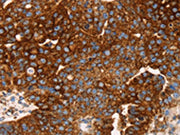 The image on the left is immunohistochemistry of paraffin-embedded Human breast cancer tissue using CSB-PA083210(EDAR Antibody) at dilution 1/45, on the right is treated with synthetic peptide. (Original magnification: ×200)
