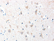 The image on the left is immunohistochemistry of paraffin-embedded Human brain tissue using CSB-PA083230(ADAM20 Antibody) at dilution 1/30, on the right is treated with fusion protein. (Original magnification: ×200)