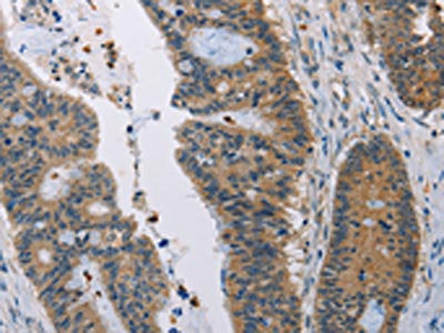 The image on the left is immunohistochemistry of paraffin-embedded Human colon cancer tissue using CSB-PA083278(AMBP Antibody) at dilution 1/35, on the right is treated with fusion protein. (Original magnification: ×200)
