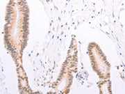 The image on the left is immunohistochemistry of paraffin-embedded Human colon cancer tissue using CSB-PA083402(ADAM12 Antibody) at dilution 1/30, on the right is treated with synthetic peptide. (Original magnification: ×200)