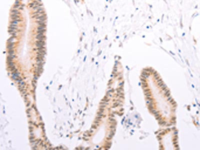The image on the left is immunohistochemistry of paraffin-embedded Human colon cancer tissue using CSB-PA083402(ADAM12 Antibody) at dilution 1/30, on the right is treated with synthetic peptide. (Original magnification: ×200)