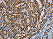 The image on the left is immunohistochemistry of paraffin-embedded Human thyroid cancer tissue using CSB-PA083456(MTCH2 Antibody) at dilution 1/45, on the right is treated with fusion protein. (Original magnification: ×200)