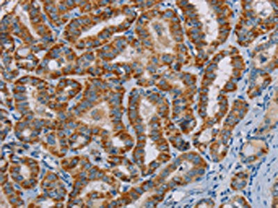 The image on the left is immunohistochemistry of paraffin-embedded Human thyroid cancer tissue using CSB-PA083456(MTCH2 Antibody) at dilution 1/45, on the right is treated with fusion protein. (Original magnification: ×200)