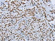 The image on the left is immunohistochemistry of paraffin-embedded Human prostate cancer tissue using CSB-PA083549(FOXE1 Antibody) at dilution 1/25, on the right is treated with synthetic peptide. (Original magnification: ×200)