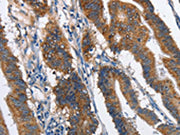 The image on the left is immunohistochemistry of paraffin-embedded Human colon cancer tissue using CSB-PA083591(MAD2L1BP Antibody) at dilution 1/60, on the right is treated with fusion protein. (Original magnification: ×200)