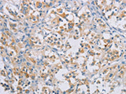 The image on the left is immunohistochemistry of paraffin-embedded Human thyroid cancer tissue using CSB-PA083613(CERKL Antibody) at dilution 1/50, on the right is treated with synthetic peptide. (Original magnification: ×200)