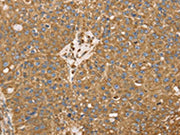The image on the left is immunohistochemistry of paraffin-embedded Human breast cancer tissue using CSB-PA083779(RRBP1 Antibody) at dilution 1/25, on the right is treated with fusion protein. (Original magnification: ×200)