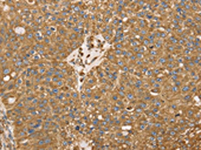 The image on the left is immunohistochemistry of paraffin-embedded Human breast cancer tissue using CSB-PA083779(RRBP1 Antibody) at dilution 1/25, on the right is treated with fusion protein. (Original magnification: ×200)