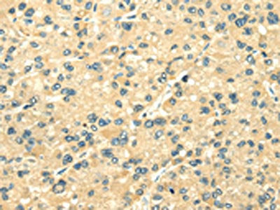 The image on the left is immunohistochemistry of paraffin-embedded Human liver cancer tissue using CSB-PA083780(TXN2 Antibody) at dilution 1/25, on the right is treated with fusion protein. (Original magnification: ×200)