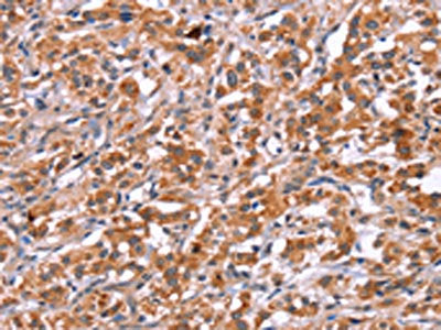 The image on the left is immunohistochemistry of paraffin-embedded Human thyroid cancer tissue using CSB-PA084116(ICAM5 Antibody) at dilution 1/25, on the right is treated with synthetic peptide. (Original magnification: ×200)