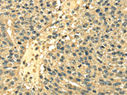 The image on the left is immunohistochemistry of paraffin-embedded Human breast cancer tissue using CSB-PA084207(RPS3 Antibody) at dilution 1/25, on the right is treated with fusion protein. (Original magnification: ×200)