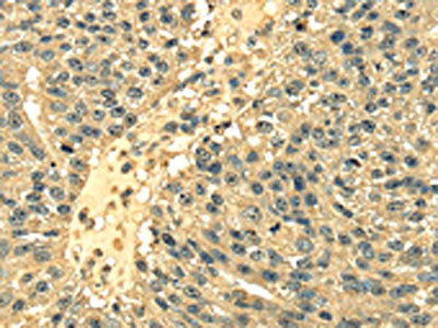 The image on the left is immunohistochemistry of paraffin-embedded Human breast cancer tissue using CSB-PA084207(RPS3 Antibody) at dilution 1/25, on the right is treated with fusion protein. (Original magnification: ×200)
