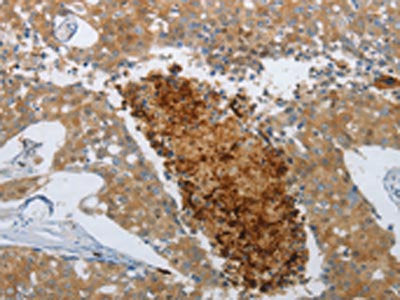The image on the left is immunohistochemistry of paraffin-embedded Human breast cancer tissue using CSB-PA084270(NGFR Antibody) at dilution 1/50, on the right is treated with synthetic peptide. (Original magnification: ×200)