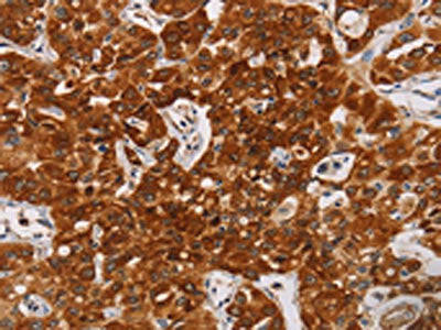 The image on the left is immunohistochemistry of paraffin-embedded Human lung cancer tissue using CSB-PA084372(CDC27 Antibody) at dilution 1/20, on the right is treated with synthetic peptide. (Original magnification: ×200)