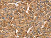 The image on the left is immunohistochemistry of paraffin-embedded Human liver cancer tissue using CSB-PA084430(RFFL Antibody) at dilution 1/20, on the right is treated with fusion protein. (Original magnification: ×200)