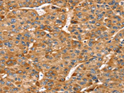 The image on the left is immunohistochemistry of paraffin-embedded Human liver cancer tissue using CSB-PA084430(RFFL Antibody) at dilution 1/20, on the right is treated with fusion protein. (Original magnification: ×200)