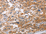 The image on the left is immunohistochemistry of paraffin-embedded Human esophagus cancer tissue using CSB-PA084492(NLRP3 Antibody) at dilution 1/15, on the right is treated with fusion protein. (Original magnification: ×200)