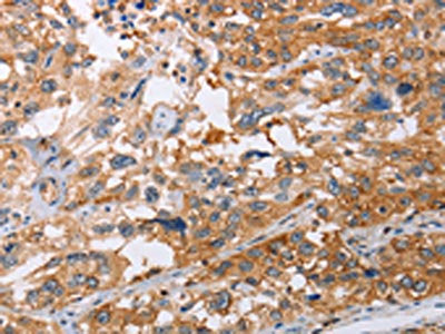 The image on the left is immunohistochemistry of paraffin-embedded Human esophagus cancer tissue using CSB-PA084492(NLRP3 Antibody) at dilution 1/15, on the right is treated with fusion protein. (Original magnification: ×200)