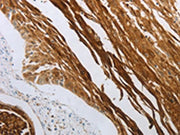 The image on the left is immunohistochemistry of paraffin-embedded Human cervical cancer tissue using CSB-PA084572(NOTCH1 Antibody) at dilution 1/40, on the right is treated with synthetic peptide. (Original magnification: x200)