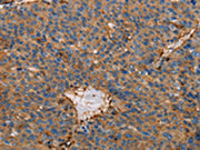 The image on the left is immunohistochemistry of paraffin-embedded Human liver cancer tissue using CSB-PA084581(ACTA1 Antibody) at dilution 1/65, on the right is treated with fusion protein. (Original magnification: ×200)