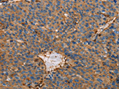 The image on the left is immunohistochemistry of paraffin-embedded Human liver cancer tissue using CSB-PA084581(ACTA1 Antibody) at dilution 1/65, on the right is treated with fusion protein. (Original magnification: ×200)