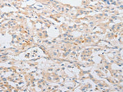 The image on the left is immunohistochemistry of paraffin-embedded Human thyroid cancer tissue using CSB-PA084633(SERPINE2 Antibody) at dilution 1/20, on the right is treated with fusion protein. (Original magnification: ×200)