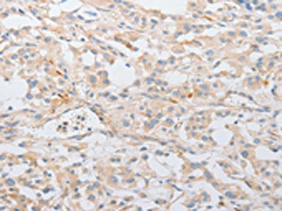 The image on the left is immunohistochemistry of paraffin-embedded Human thyroid cancer tissue using CSB-PA084633(SERPINE2 Antibody) at dilution 1/20, on the right is treated with fusion protein. (Original magnification: ×200)
