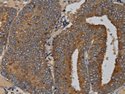 The image on the left is immunohistochemistry of paraffin-embedded Human colon cancer tissue using CSB-PA084695(MAS1 Antibody) at dilution 1/50, on the right is treated with fusion protein. (Original magnification: ×200)