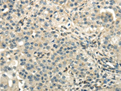 The image on the left is immunohistochemistry of paraffin-embedded Human breast cancer tissue using CSB-PA084734(DLAT Antibody) at dilution 1/40, on the right is treated with fusion protein. (Original magnification: ×200)