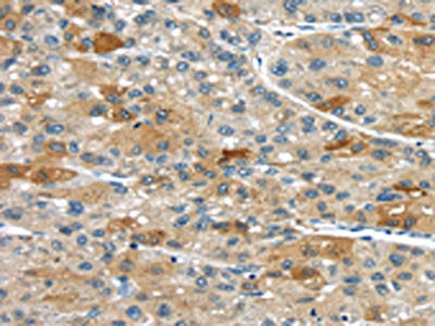 The image on the left is immunohistochemistry of paraffin-embedded Human liver cancer tissue using CSB-PA084938(UPP2 Antibody) at dilution 1/35, on the right is treated with synthetic peptide. (Original magnification: ×200)