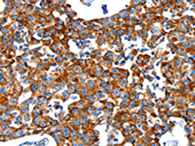The image on the left is immunohistochemistry of paraffin-embedded Human breast cancer tissue using CSB-PA085005(KLK2 Antibody) at dilution 1/80, on the right is treated with synthetic peptide. (Original magnification: ×200)