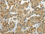 The image on the left is immunohistochemistry of paraffin-embedded Human liver cancer tissue using CSB-PA085315(UGT2B4 Antibody) at dilution 1/20, on the right is treated with fusion protein. (Original magnification: ×200)
