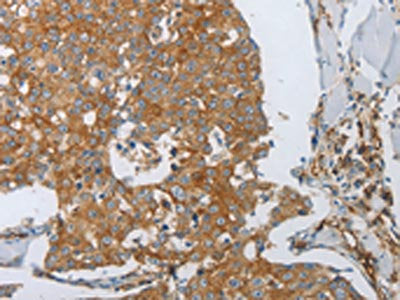 The image on the left is immunohistochemistry of paraffin-embedded Human breast cancer tissue using CSB-PA085447(PECAM1 Antibody) at dilution 1/30, on the right is treated with synthetic peptide. (Original magnification: ×200)