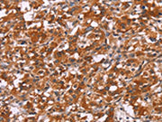 The image on the left is immunohistochemistry of paraffin-embedded Human thyroid cancer tissue using CSB-PA085605(HSPB6 Antibody) at dilution 1/30, on the right is treated with synthetic peptide. (Original magnification: ×200)