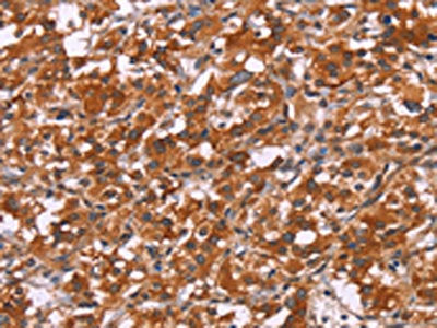 The image on the left is immunohistochemistry of paraffin-embedded Human thyroid cancer tissue using CSB-PA085605(HSPB6 Antibody) at dilution 1/30, on the right is treated with synthetic peptide. (Original magnification: ×200)