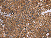 The image on the left is immunohistochemistry of paraffin-embedded Human ovarian cancer tissue using CSB-PA085809(PPIB Antibody) at dilution 1/45, on the right is treated with fusion protein. (Original magnification: ×200)