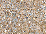 The image on the left is immunohistochemistry of paraffin-embedded Human ovarian cancer tissue using CSB-PA085970(RBM5 Antibody) at dilution 1/30, on the right is treated with fusion protein. (Original magnification: ×200)