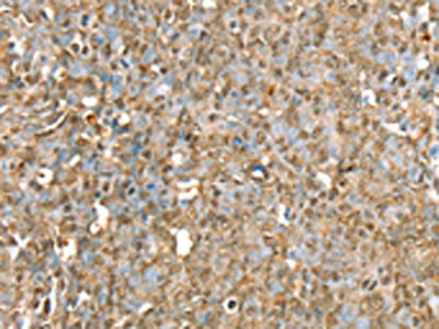 The image on the left is immunohistochemistry of paraffin-embedded Human ovarian cancer tissue using CSB-PA085970(RBM5 Antibody) at dilution 1/30, on the right is treated with fusion protein. (Original magnification: ×200)