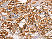 The image on the left is immunohistochemistry of paraffin-embedded Human thyroid cancer tissue using CSB-PA086010(CABLES2 Antibody) at dilution 1/25, on the right is treated with synthetic peptide. (Original magnification: ×200)