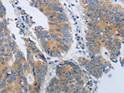 The image on the left is immunohistochemistry of paraffin-embedded Human colon cancer tissue using CSB-PA086078(MME Antibody) at dilution 1/45, on the right is treated with synthetic peptide. (Original magnification: ×200)