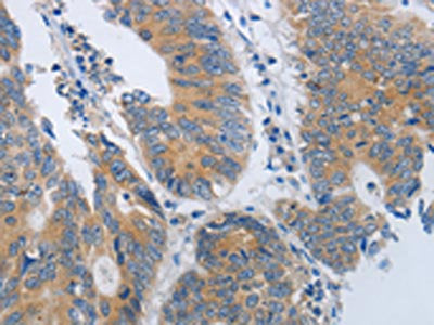 The image on the left is immunohistochemistry of paraffin-embedded Human colon cancer tissue using CSB-PA086078(MME Antibody) at dilution 1/45, on the right is treated with synthetic peptide. (Original magnification: ×200)