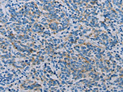 The image on the left is immunohistochemistry of paraffin-embedded Human breast cancer tissue using CSB-PA086155(CLDN4 Antibody) at dilution 1/35, on the right is treated with synthetic peptide. (Original magnification: ×200)