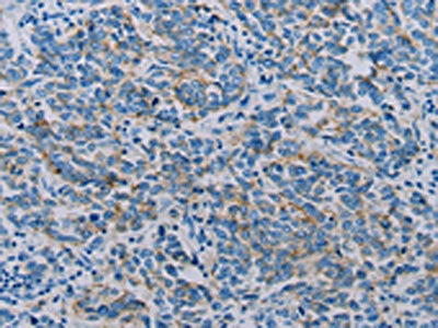 The image on the left is immunohistochemistry of paraffin-embedded Human breast cancer tissue using CSB-PA086155(CLDN4 Antibody) at dilution 1/35, on the right is treated with synthetic peptide. (Original magnification: ×200)