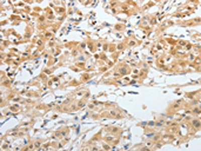 The image on the left is immunohistochemistry of paraffin-embedded Human liver cancer tissue using CSB-PA086320(BPIFB2 Antibody) at dilution 1/45, on the right is treated with synthetic peptide. (Original magnification: ×200)
