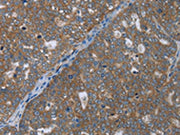 The image on the left is immunohistochemistry of paraffin-embedded Human ovarian cancer tissue using CSB-PA086437(GABRB1 Antibody) at dilution 1/50, on the right is treated with fusion protein. (Original magnification: ×200)