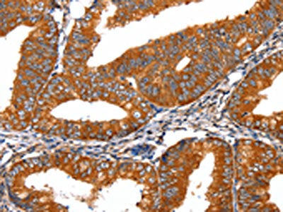The image on the left is immunohistochemistry of paraffin-embedded Human cervical cancer tissue using CSB-PA086441(FGFR1 Antibody) at dilution 1/60, on the right is treated with fusion protein. (Original magnification: ×200)