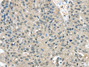 The image on the left is immunohistochemistry of paraffin-embedded Human breast cancer tissue using CSB-PA086603(TXNDC17 Antibody) at dilution 1/30, on the right is treated with fusion protein. (Original magnification: ×200)